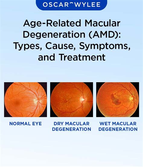 amd eye disease|symptoms of macular degeneration in eyes.